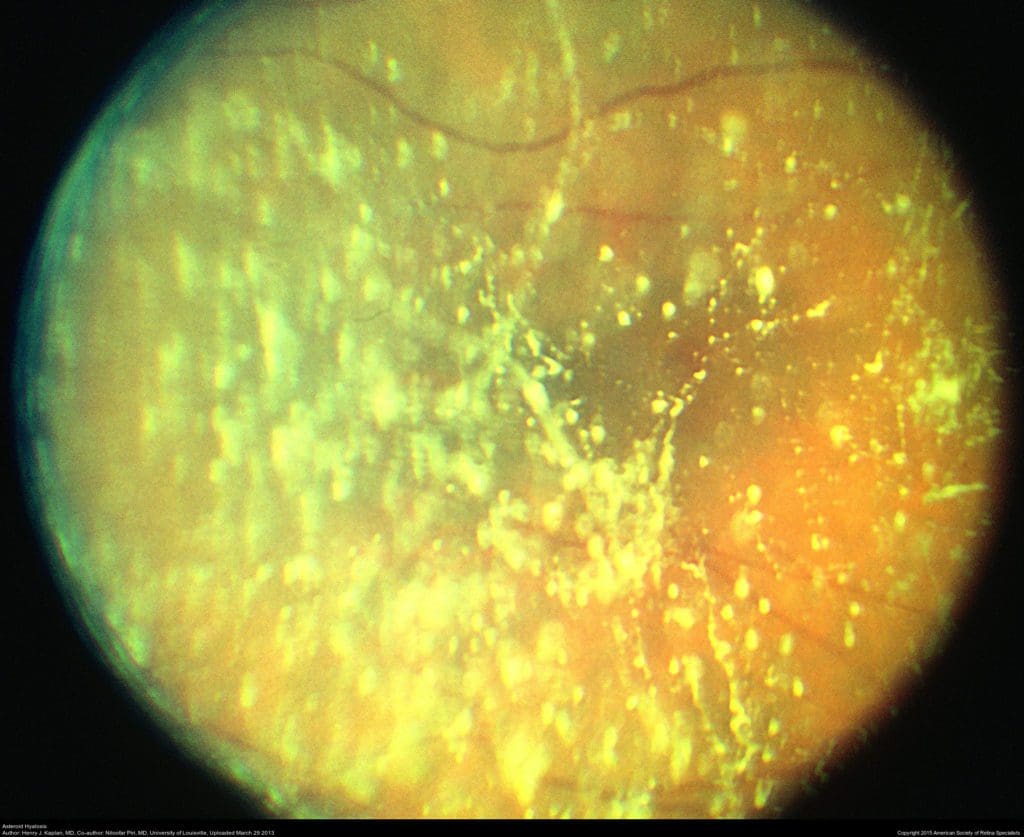 A picture of an eye with yellow light coming from it.