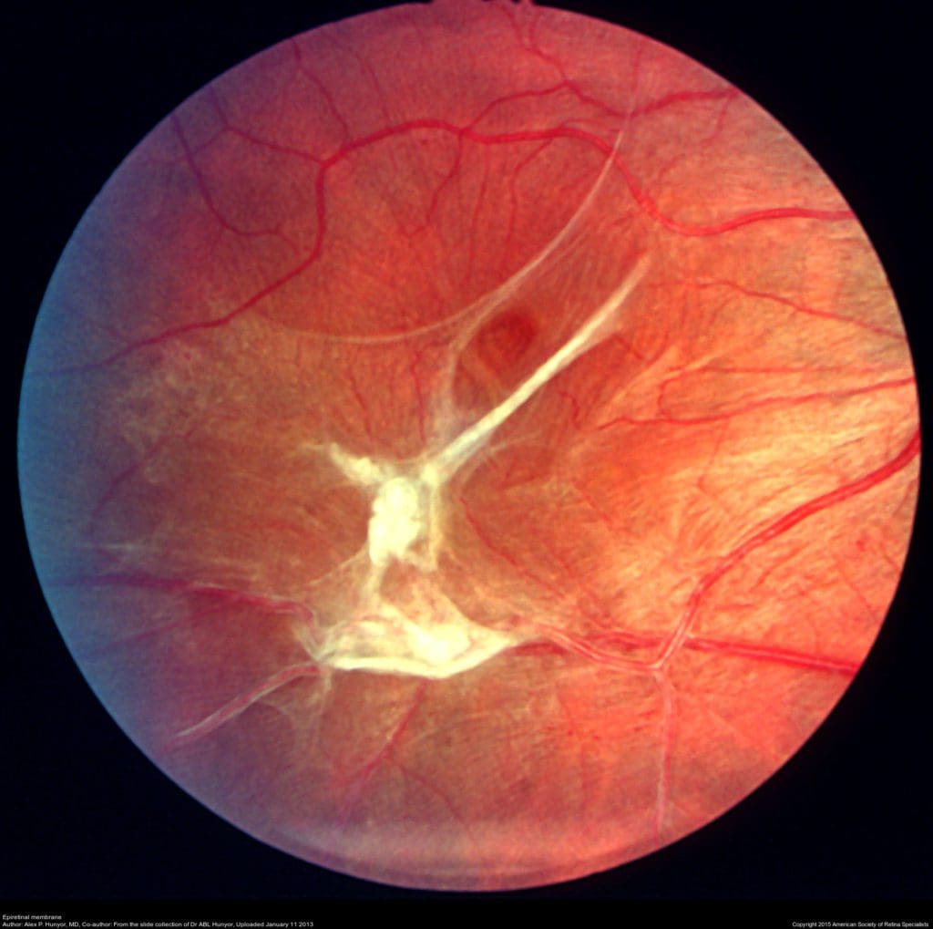 A picture of an eye with the retina in focus.