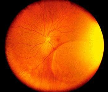 A picture of an eye with the retina in focus.